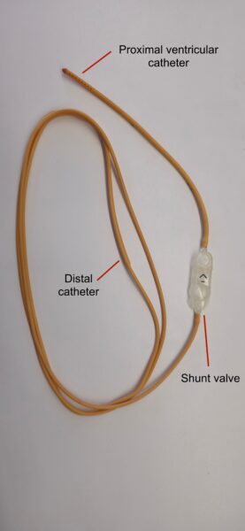 shunt occlusion 2
