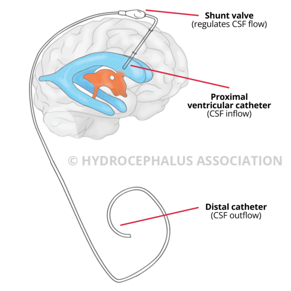 shunt occlusion 1