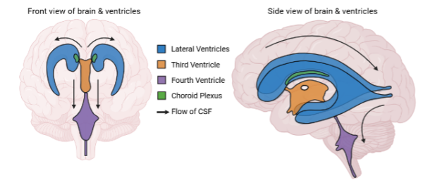 hydrocephalus